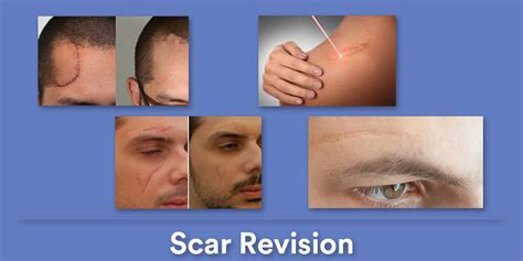 Scar Revision Procedure 的图像结果