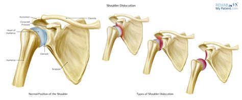 Shoulder Dislocation Contortion 的图像结果