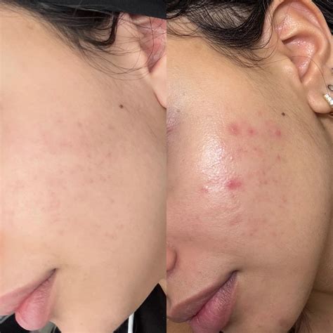 Oil Control Serum | 5% Niacinamide + Hyaluronic Acid Serum | 30 ml ...