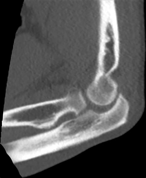Traumatic elbow arthrotomy after motorcycle accident not evident on CT | BMJ Case Reports