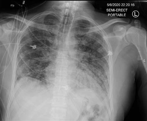 Ards Chest X Ray