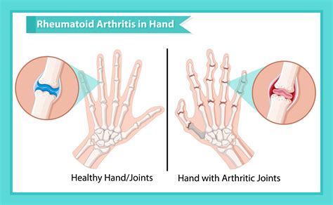 What’s the Difference Between Arthritis and Carpal Tunnel ...