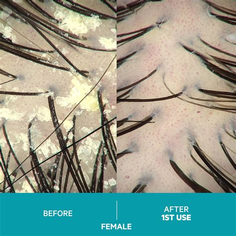 Buy Dandrene Anti-Dandruff Conditioner Online.