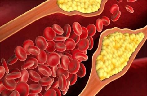 Cholesterol Alert: हाई कोलेस्ट्रॉल के शुरुआती लक्षणों को न करें ...