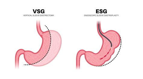 Premium Vector | Endoscopic sleeve gastroplasty and gastrectomy operation Stomach surgery weight ...