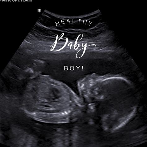 Baby Boy In Ultrasound 20 Weeks at Shawn Keim blog