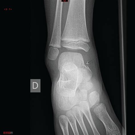 Talus fracture in a 4-year-old child | BMJ Case Reports
