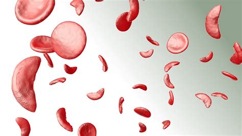 Oral Etavopivat Is Effective for Sickle Cell Disease Treatment in Phase ...