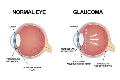 Image result for Common Eye Problems