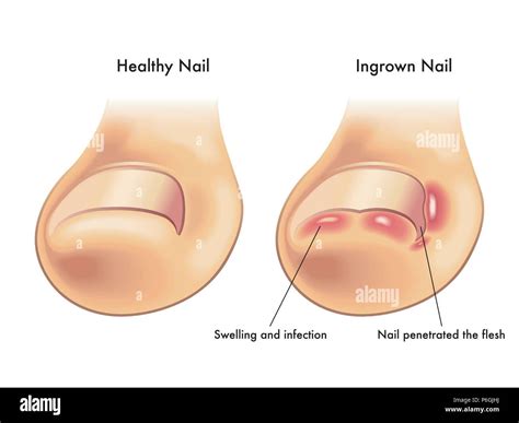 Ingrown toenails hi-res stock photography and images - Alamy