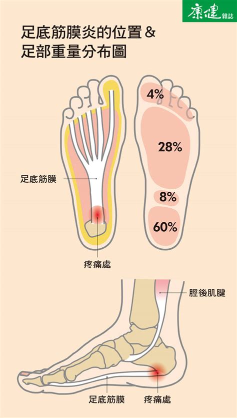 久站、久走腳底痛怎麼辦?足底筋膜炎舒緩、快速有效的治療方法 | 維力骨科診所