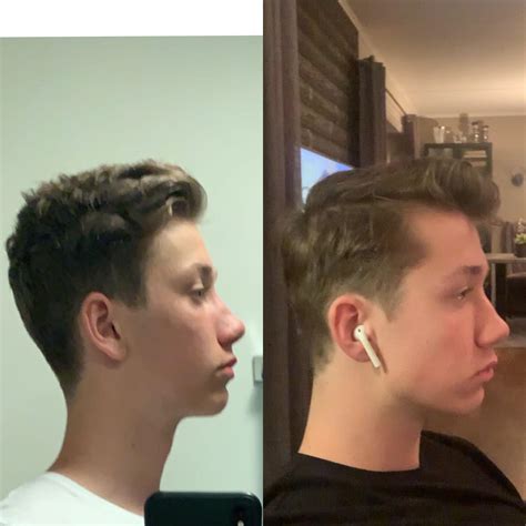 4ish Months Of Mewing, Falim Gum Chewing, Some (16 Y/o) , 48% OFF