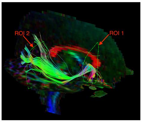 Serum Inflammatory Markers and Integrity of the Superior Longitudinal ...