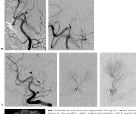 Figure 1 from Artery of Percheron thrombolysis. | Semantic Scholar