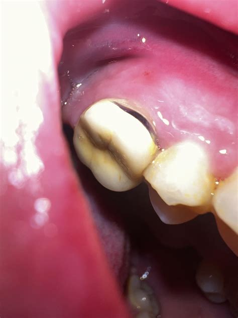 Can someone tell me what this is? Noticed like a week ago. Went to the dentist and while I was ...