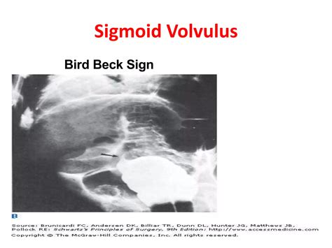 Volvulus of colon | PPTX