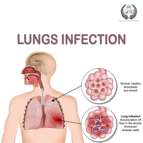 Causes Of Lung Inflammation | Understanding Lung Infection: Causes, Symptoms, and Treatment – EDKNFQ
