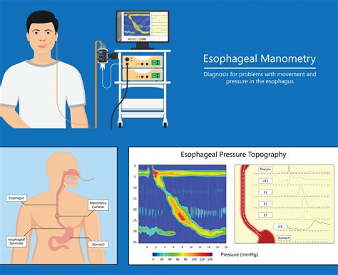 Manometry Test 的图像结果