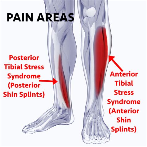 Shin Splints - The Foot Force Podiatry