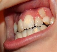 Image result for Brossage Des Dents