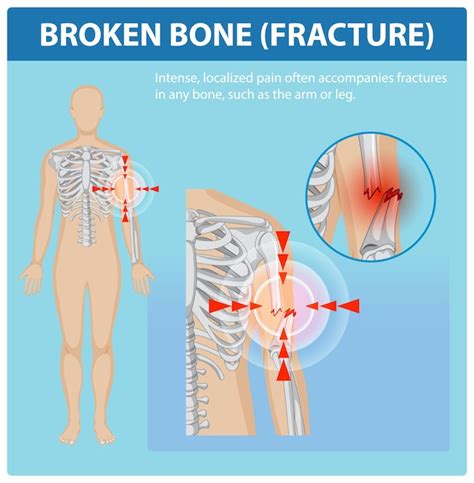 Comprendre les fractures osseuses et la douleur | Vecteur Gratuite