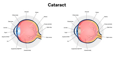 Vision Disorder 的图像结果
