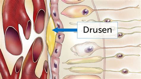 Drusen Eye Condition