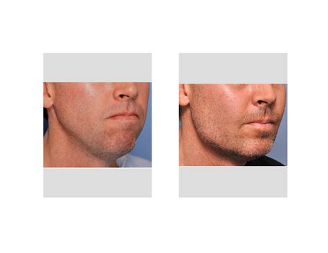 Case Study: Jaw Angle Implants in Jawline Enhancement - Explore Plastic Surgery
