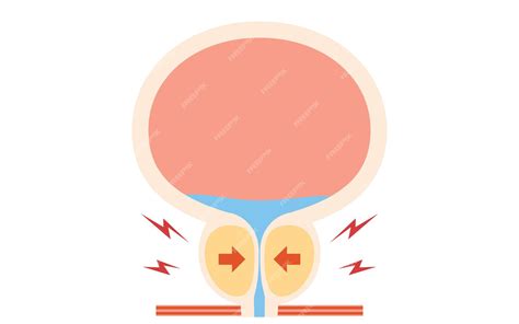 Ilustración médica de la hiperplasia prostática benigna y el ...