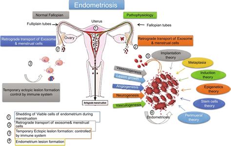 Endometriosis and subfertility - Clinical Tree