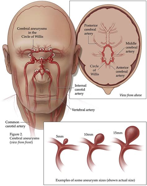 Intracranial Aneurysm Nonruptured Cerebral Aneurysm What You Need To