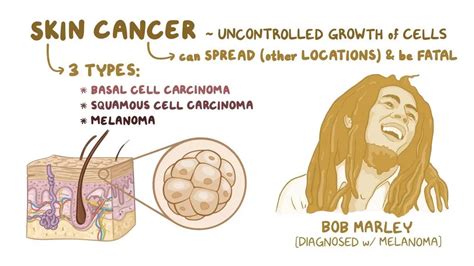 Image result for How Skin Cancer Forms