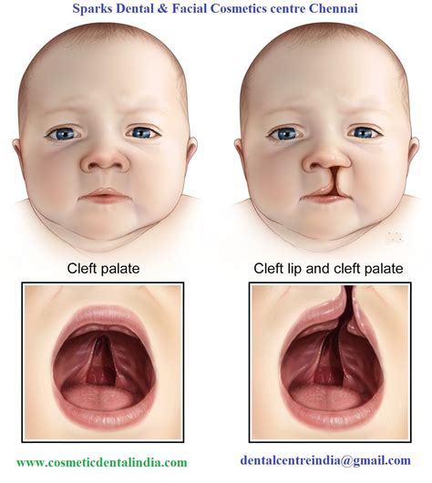 Cleft lip and cleft palate are the two common congenital deformities that affect individuals ...