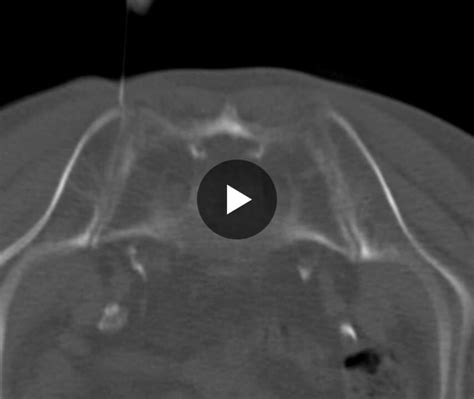 Image result for SI Joint Injection Procedure