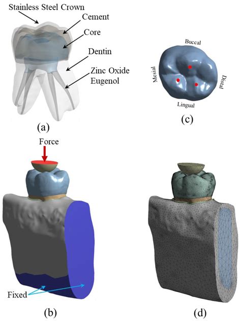 Finite Element Analysis of the Mechanical Performance of Non-Restorable Crownless Primary Molars ...