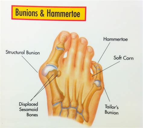 Bunions | Foot & Ankle Doctors, Inc.