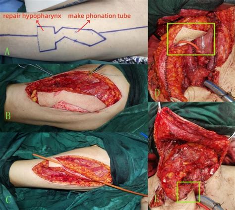 Preliminary Study on Phonation Reconstruction Using Free Anterolateral ...