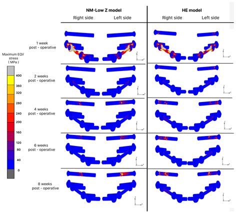 Finite Element Analysis of Mandibular Advancement Comparing Hunsuck ...