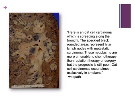 Lung Cancer Pathology & Clinical | PPTX