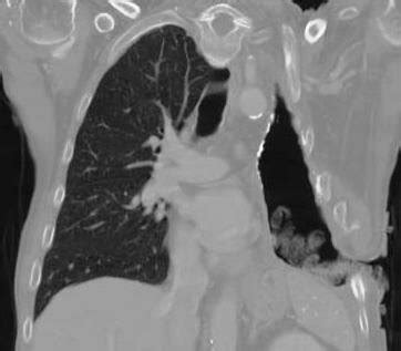 Image result for Open Chest Thoracotomy