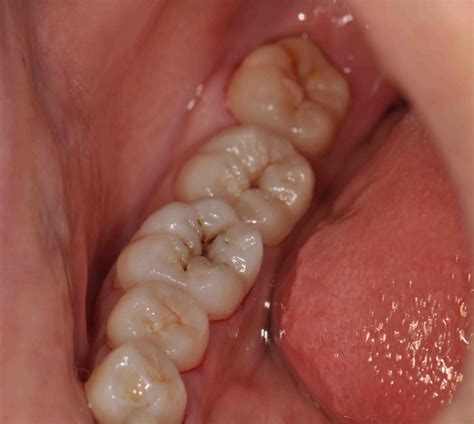 Dental Care as a University Student | dentael