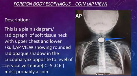 Foreign Body In The Esophagus X Ray: Radiologic Evaluation Guide