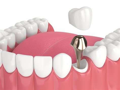 What is Post and Core? | Cromwell Dentists