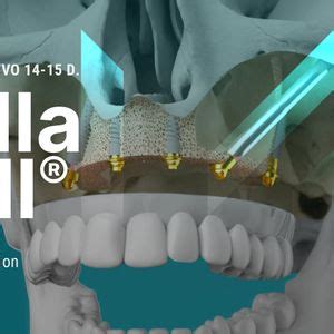 Maxilla-for-All: Master the Extreme in the Full Arch Immediate ...