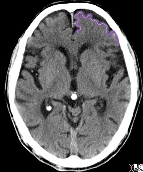 Image result for Prefrontal Cortex Location