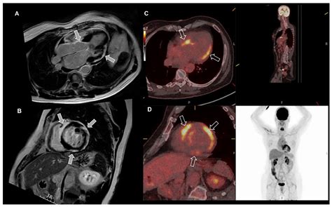 State-of-the-Art Multimodality Imaging in Sudden Cardiac Arrest with ...