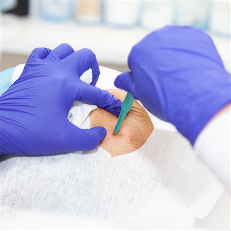 Skin Punch Biopsy Info