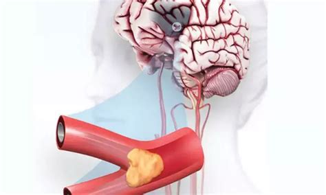 Higher levels of small dense LDL cholesterol robustly associated with ...