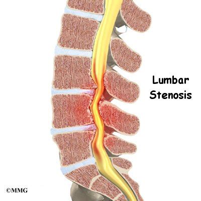 https://eorthopod.com/sites/default/files/images/lumbar_stenosis_intro01.jpg