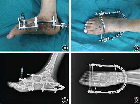 Staged Management of Missed Lisfranc Injuries: A Report of Short‐term ...